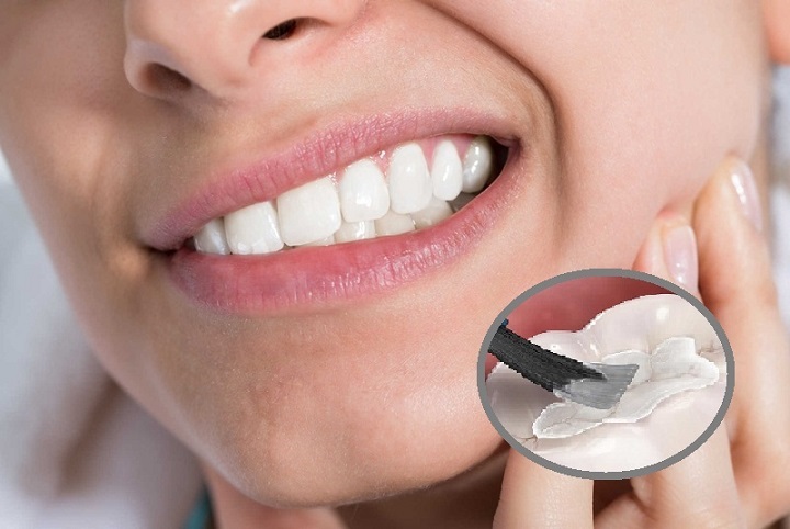 Nha sĩ tạo khoang trám để lưu trữ vật liệu trong khoang đảm bảo lấp đầy phần răng bị mất