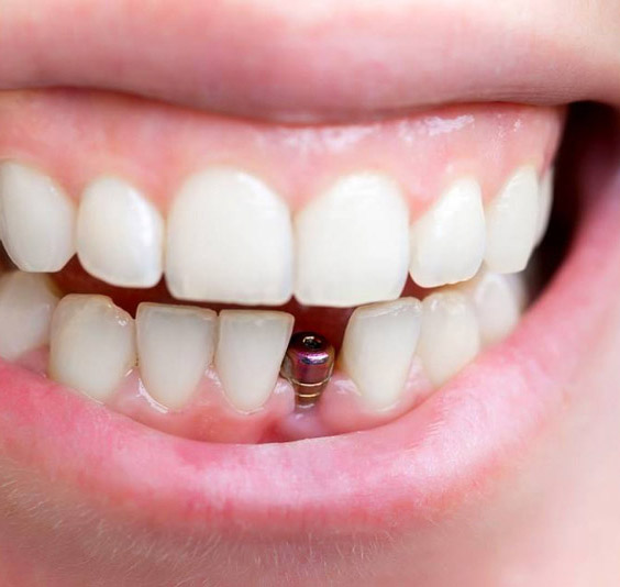 Cắm ghép Implant