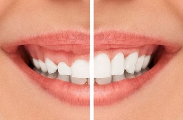 Cắt lợi thẩm mỹ