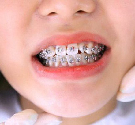Niềng răng trẻ em