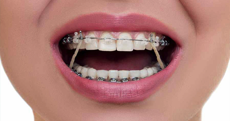 Những lợi ích khi niềng răng sớm